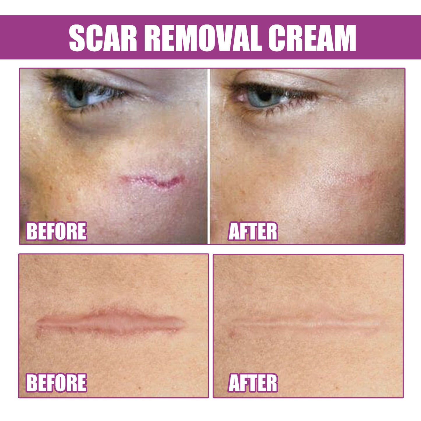 Scar Removal Cream